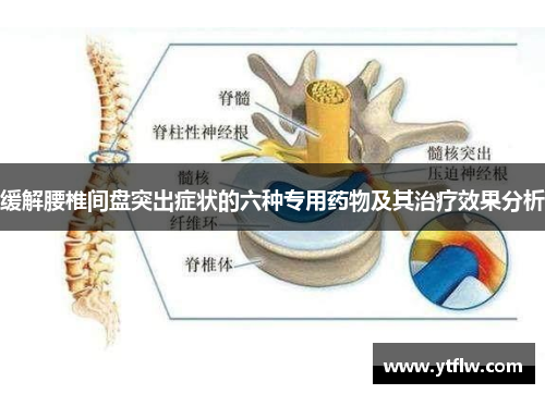 缓解腰椎间盘突出症状的六种专用药物及其治疗效果分析